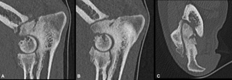 Newly Identified Elbow Injury in Dogs: Acute Osteophyte Fractures Revealed by CT