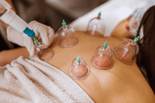 Is Cupping Therapy Right for You? Here’s What to Know