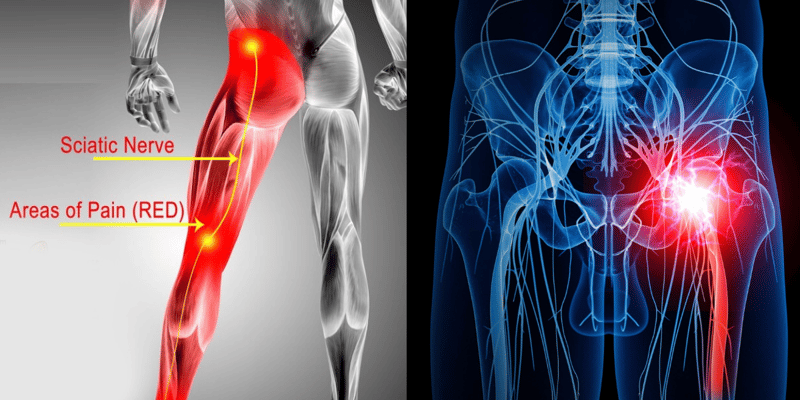 Unlock Relief: A Systematic Approach to Solving Sciatica Nerve Pain