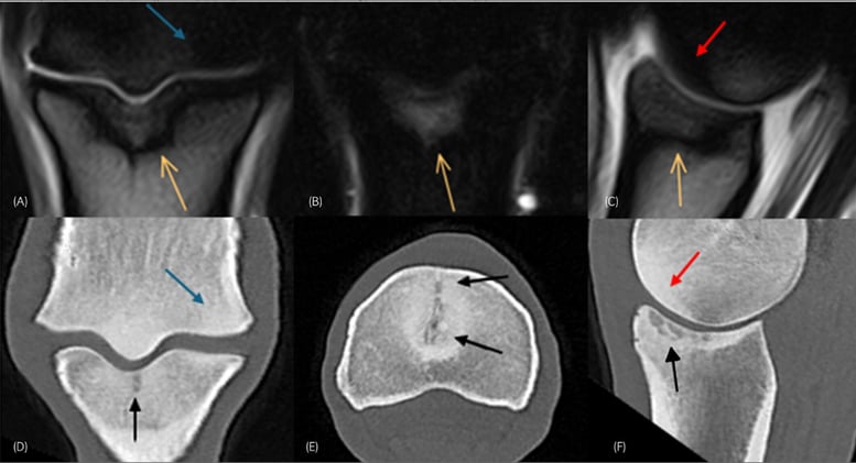 Seeing the Whole Picture: MRI and CT Together Improve Diagnosis of Equine Fetlock Pain