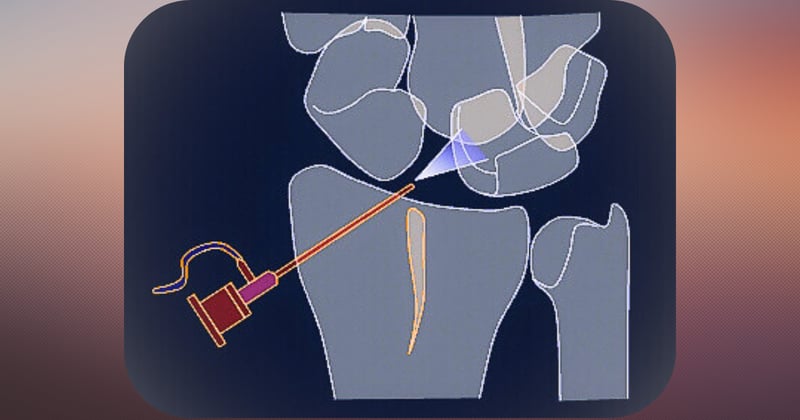 #6. Dolor tras reparación artroscópica ligamento escafolunar.
