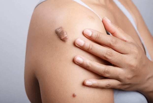 Ways to Treat and Reduce Keloids