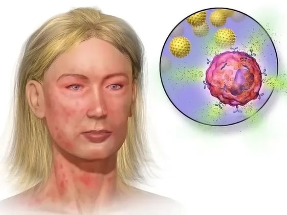 Could Mast Cell Activation Be Behind Your Symptoms