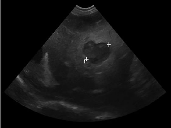 Hepatic abscess-indeed they need to go to surgery