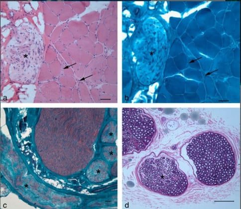 Chronic-Relapsing Polyneuropathy Identified in Young Bengal Cats: Clinical Course and Prognosis