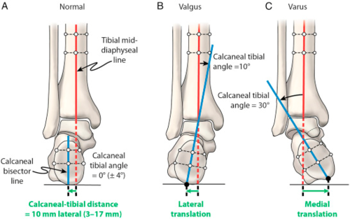 Análisis De Lesión: Fasciitis Plantar
