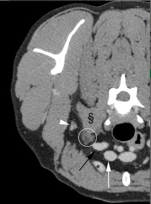 What Does a “Normal” Canine Brachial Plexus Look Like on CT? New Size & Interpretation Guidelines