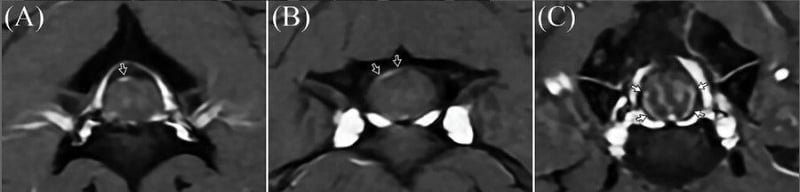 Normal cervical meningeal enhancement on MRI in healthy dogs: what radiologists should recognize