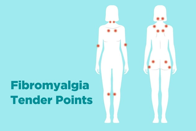 Fibromyalgia Diagnosis 