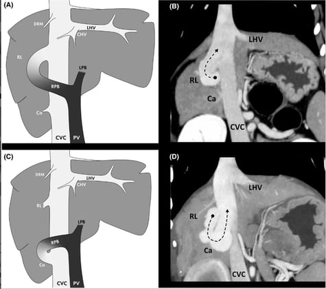Classify your intrahepatic shunt....