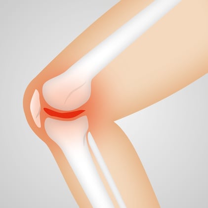 ACL Tear and Injury