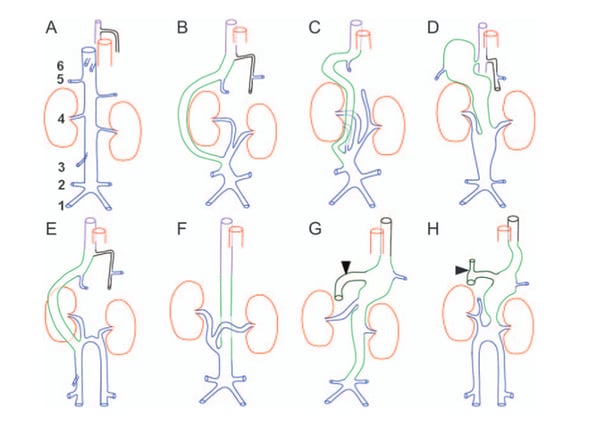 Where do the blood goes if there is no caudal vena cava?