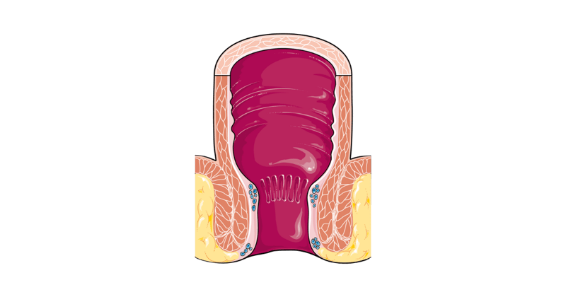 🩺 #34 - Rectal Bleeding and Fatigue