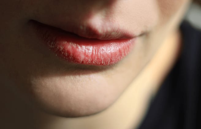 Recognizing and Treating Oral Thrush on the Lips