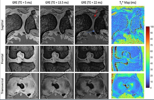 Detecting Subtle Meniscal Degeneration in Dogs: MTsat and T1 Mapping Show Promise