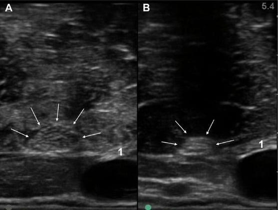When Endurance Takes Its Toll: Ultrasound Diagnosis of Femoral Nerve Neuropathy in a Sport Horse