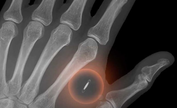 Swiss man makes history with implantable Bitcoin chip