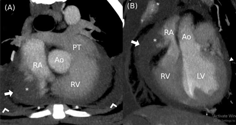 Cardiac-Gated CT Improves Detection, Staging, and Surgical Planning for Canine Right Auricular Masses