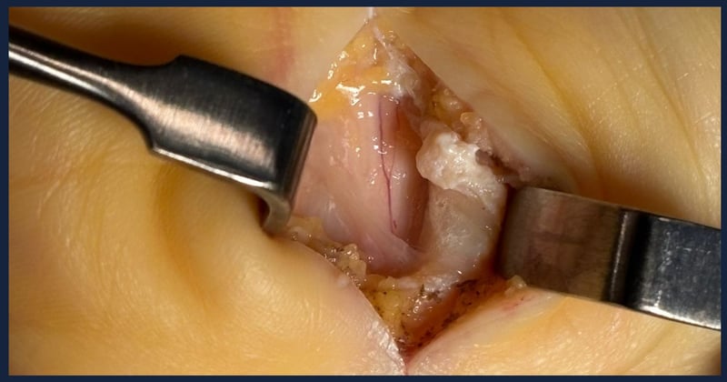 #7. Túnel carpiano bien descomprimido... pero el paciente puede no “curarse”.