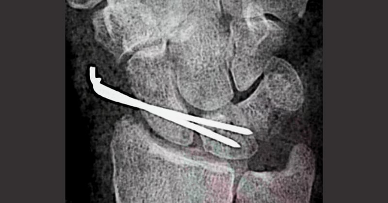 #5. Ligamento escafosemilunar. Cirugía abierta.