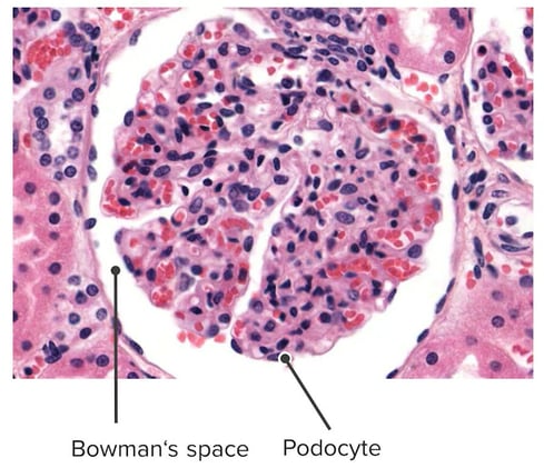 Which of the following is the most likely diagnosis?