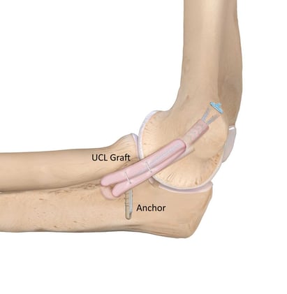 Nuevo Procedimiento de Tommy John Anunciado por el Dr. Ahmad (NY Yankees)