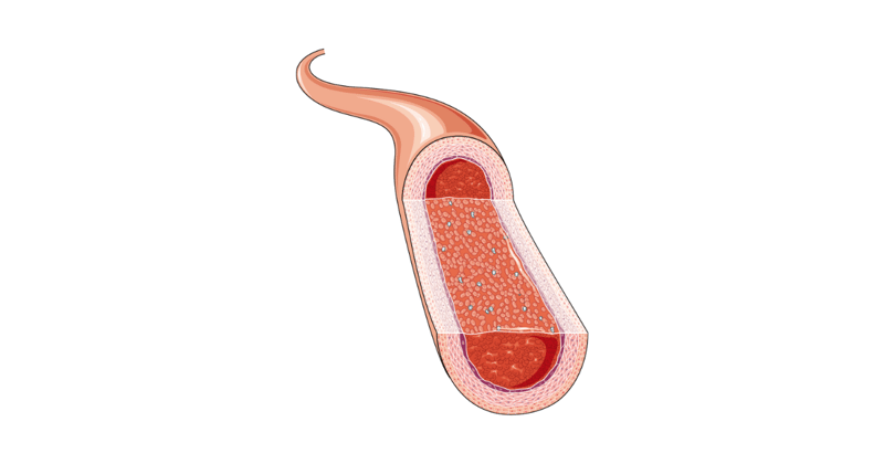 🩺 #33 - Calf Pain and Weak Pulses