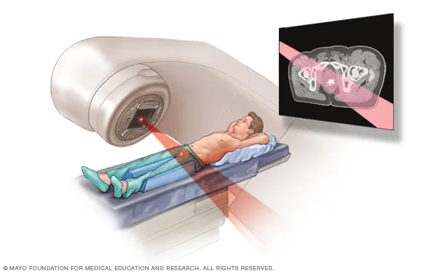 🌟 Radioterapia en abdomen y pelvis: cuidados clave para proteger tu cuerpo