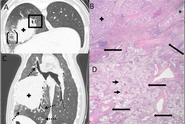 When Bronchovascular Bundle Thickening Signals More: CT–Histopathology Correlation in Canine Pulmonary Carcinoma
