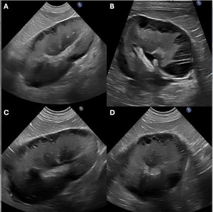 First Canine Case of Renal Lymphangiectasia Unveiled Through Ultrasound