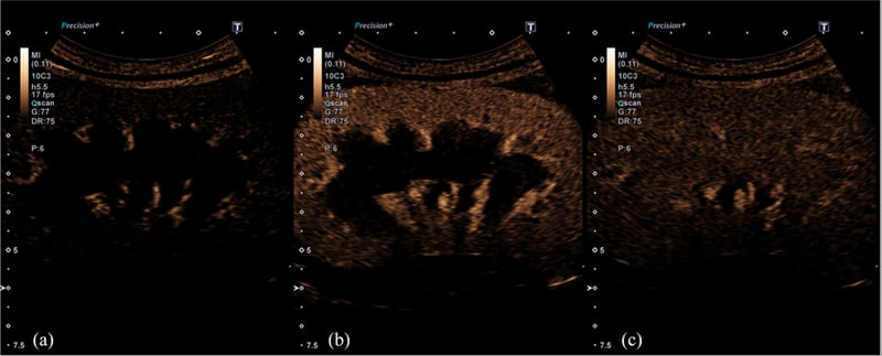 Kidney Crisis? CEUS to the Rescue!