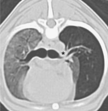Bronchial cartilage hypoplasia, an underlying cause for Congenital lobar emphysema 
