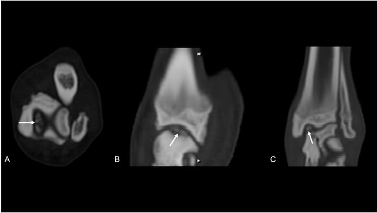 CT Reveals Density Deficits and Compensation in Canine Tarsal Osteochondrosis