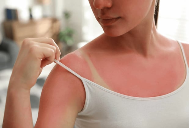 How to Tell if It’s Sunburn or Sun Poisoning and What to Do