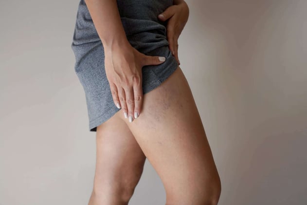 Signs of a Blood Clot in the Leg You Shouldn’t Ignore