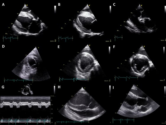 Can You Trust Your Eye? Echocardiographic Subjectivity in Equine Pulmonary Hypertension