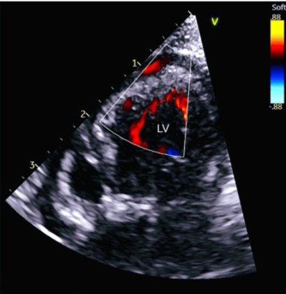 First Report of Rare Heart Disease in Guinea Pigs—Genetic Clues to Non-Compaction Cardiomyopathy