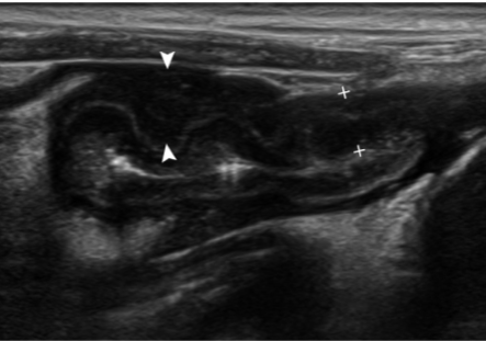 Lymphoma or histoplasmosis?