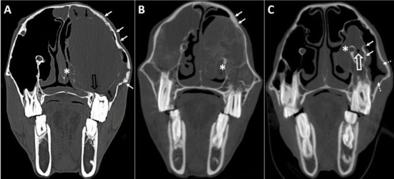 Could you differentiate paranasal sinus cysts and progressive ethmoid haematomas on CT?
