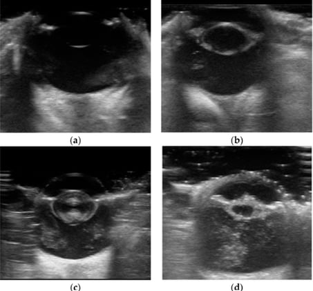 Cataract on ultrasound....