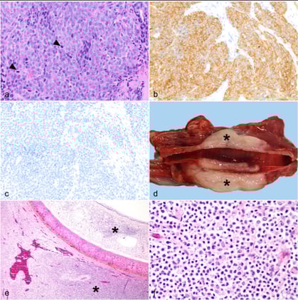 Tracheal neoplasia-refine your ddx