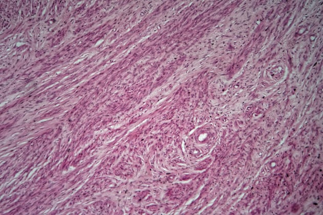 🩺 Menopause and MS: not the link you think