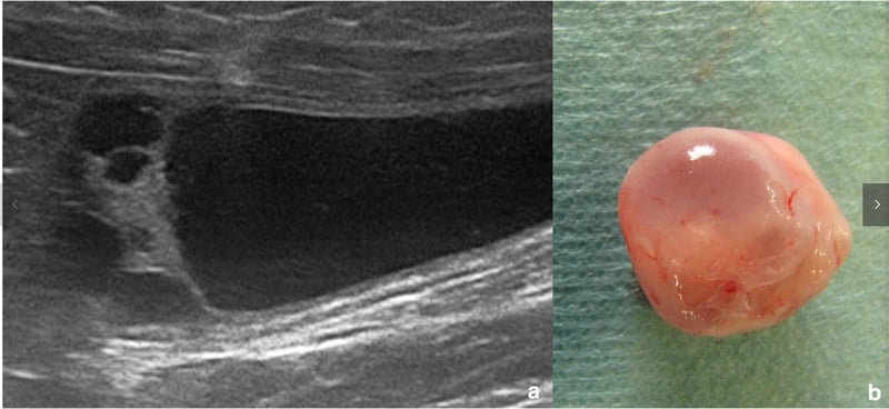 Rare Bladder Lesions in Cats: A Surgical Cure You Can See on Ultrasound