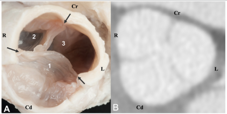 Anatomy of the right outflow tract....